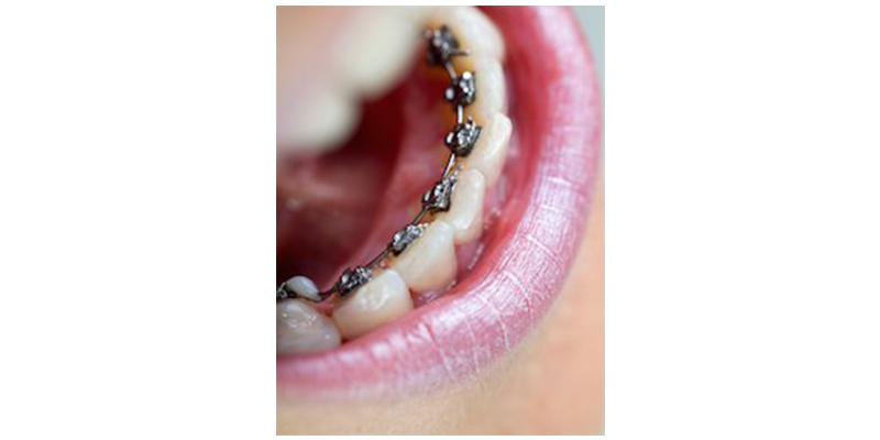Unsichtbare Zahnspangen (Lingualtechnik) – Dr. med. dent. Christina Welscher - Fachzahnärztin für Kieferorthopädie für Kinder, Jugendliche und Erwachsene - Neuötting - Landkreis Altötting