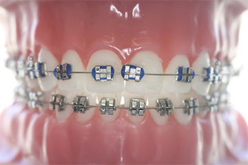 Bogenwechsel Zahnspange Tipps