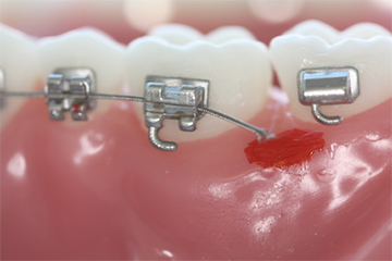 Draht der Zahnspange verrutscht