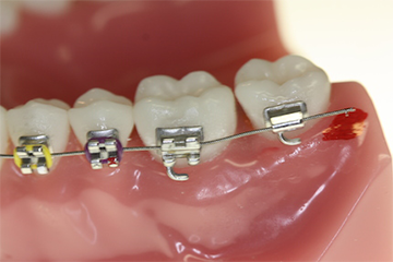 Hilfe für Zahnspangen – Dr. med. dent. Christina Welscher - Fachzahnärztin für Kieferorthopädie für Kinder, Jugendliche und Erwachsene - Neuötting - Landkreis Altötting