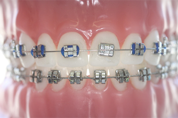 Zahnspange Hilfe bei Problemen