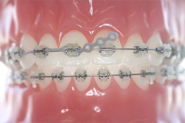 Zahnlücken Probleme