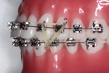 Hilfe für Zahnspangen – Dr. med. dent. Christina Welscher - Fachzahnärztin für Kieferorthopädie für Kinder, Jugendliche und Erwachsene - Neuötting - Landkreis Altötting
