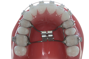 Schnarchschiene / Kiefergelenkschiene