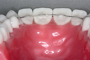 Haltebogen Klebestellen Tipps