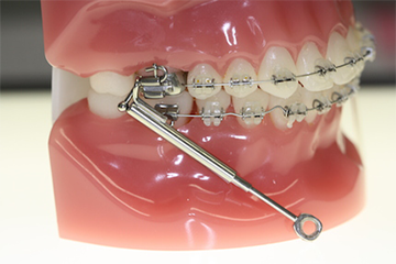 Hilfe für Zahnspangen - Kieferorthopädie